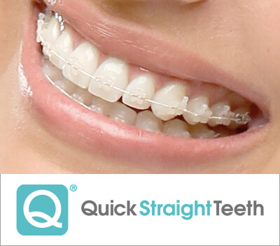 Quick Straight Teeth - Leagrave Dental Sedation Clinic